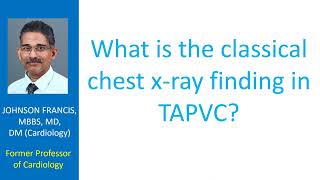 What is the classical chest x ray finding in TAPVC?