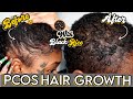 PCOS HAIR GROWTH JOURNEY | ❌ NO MORE 🚫 DRY SCALP OR BALDING | BLACK RICE OIL | Laurasia Andrea PCOS