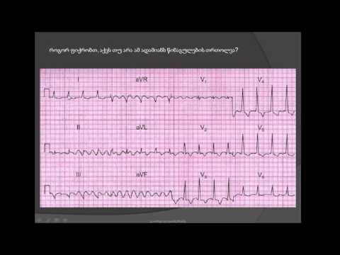ეკგ. ვპვ სინდრომი და კუნთების ტრემორი / პარკინსონის დაავადება / parkinsonis daavadeba