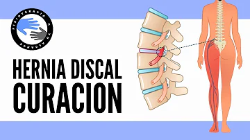 ¿Cuánto tarda en curarse una hernia discal lumbar?