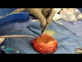 Ruptured Implant - Capsulectomy at The Park Clinic for Plastic Surgery