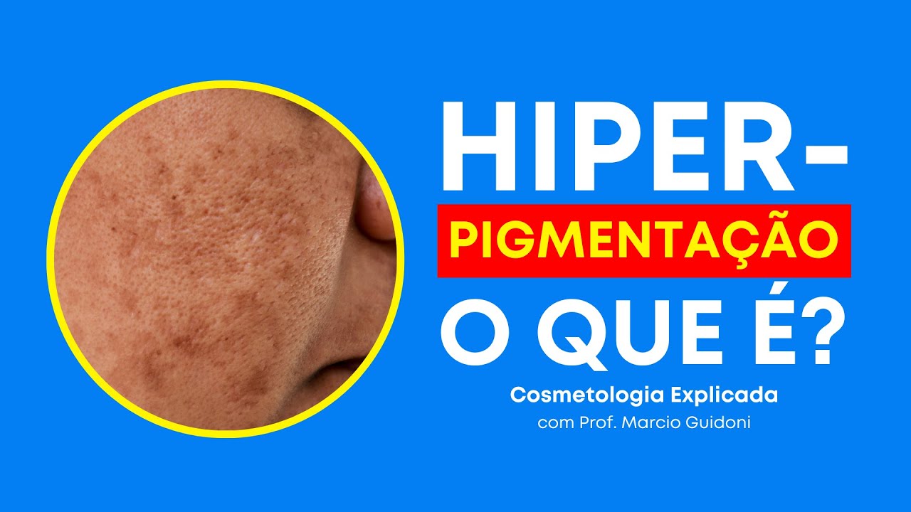 O QUE É HIPERPIGMENTAÇÃO NA PELE? | Cosmetologia Explicada com Prof ...