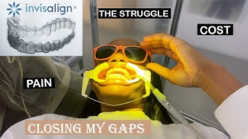 My Invisalign Journey #1 (Closing My Gaps) || First Scan, First Tray, Cost, Pain & More