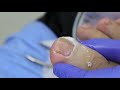 Ep_618 Ingrown nail removal 👣 เล็บจิก เล็บหนา ดูแลอย่างไร? (This video clip from thailand)