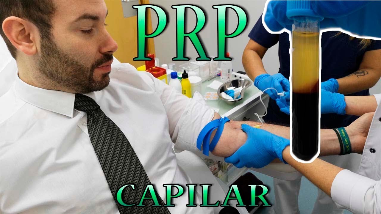PRP CAPILAR - PLASMA RICO EN PLAQUETAS