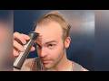 BALDING Man Has LIFE CHANGING TRANSFORMATION