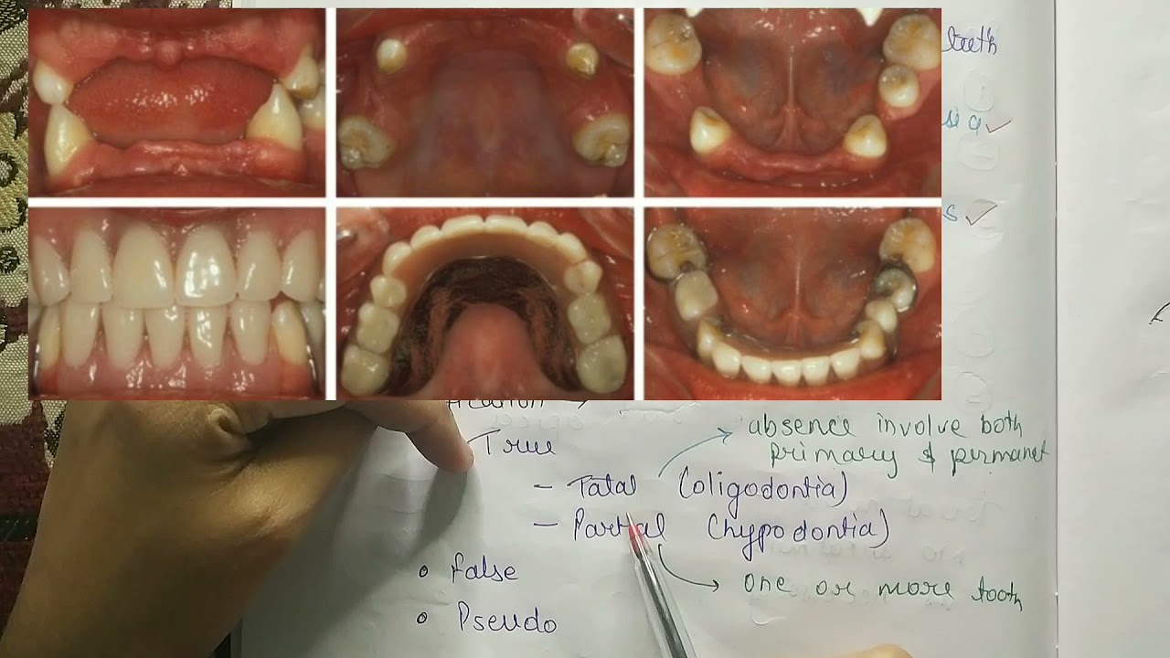 Anodontia | NEET MDS | oral pathology