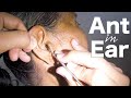 ANT Lodged &amp; Stuck Inside Elderly Woman&#39;s Ear | How It&#39;s Removed