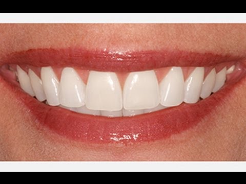 Photoshop Tutorial: How to Brighten & Whiten TEETH!