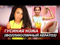 ГУСИНАЯ КОЖА // Фолликулярный кератоз: простые рекомендации  как сделать кожу гладкой