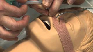 Securing a childs nasal endo tracheal tube (ETT)