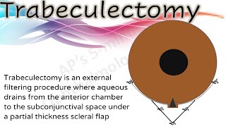 Trabeculectomy simplified for medical students