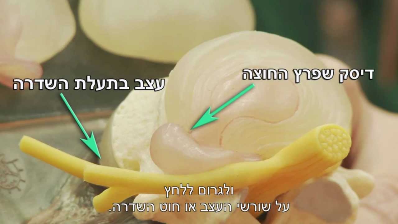 פריצת דיסק - סימפטומים ואפשרויות טיפול