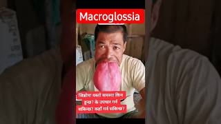 Macroglossia. #Dr.DevrajShrestha #dental #dentist #dentistry 