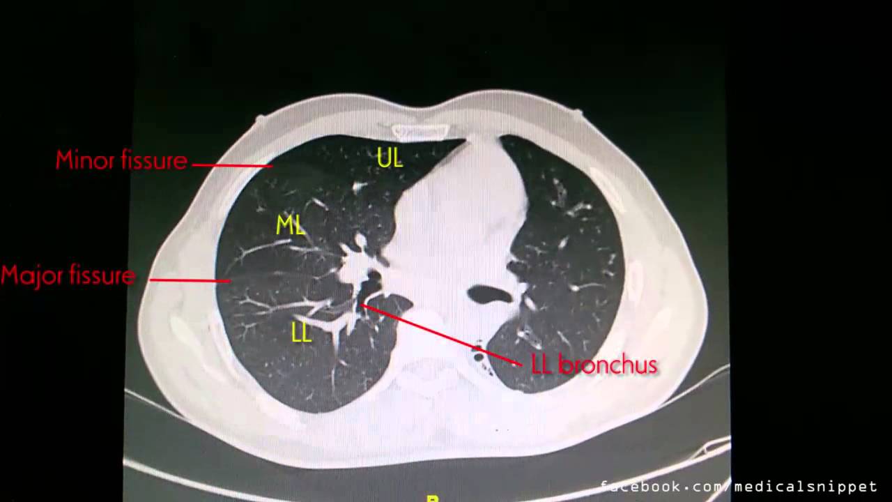 CT anatomy of Right Lung - YouTube