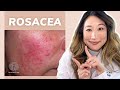 Dermatologist guide to rosacea  treatments  skincare products