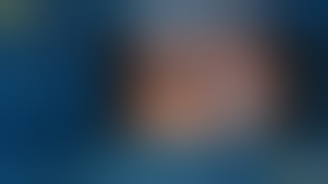 Robotic Cholecystectomy with variant anatomy on DaVinci Xi