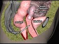 Pelvic Organ Prolapse Animation by Cal Shipley, M.D.