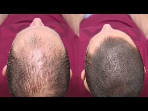 Dermmatch Hair Loss Concealer