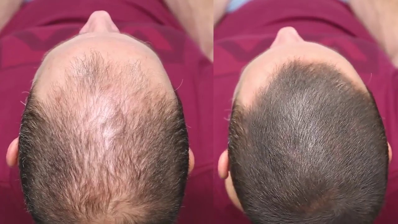 Dermmatch Hair Loss Concealer