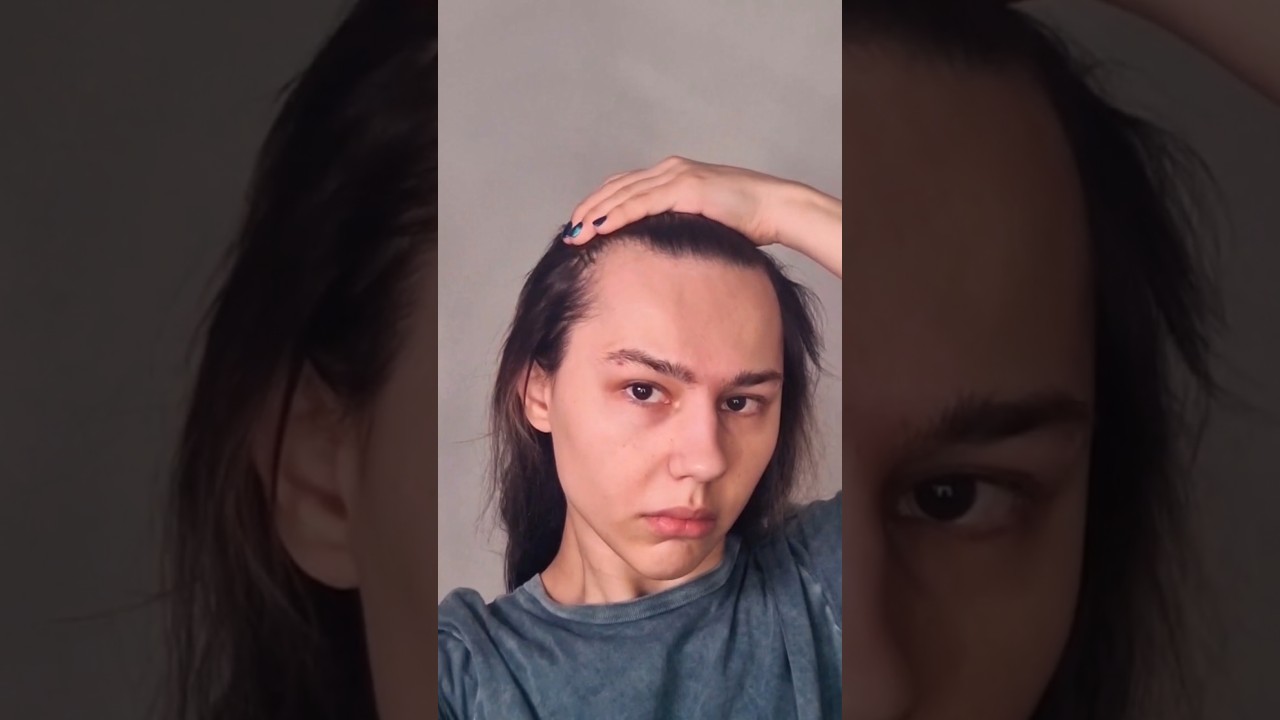 Trans hairline regrowth/восстанавление волос после отката 