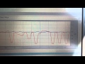 Using upstream and downstream oxygen sensors to test the catalytic converter