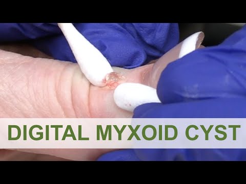We love a Digital Myxoid Cyst | Dr. Derm