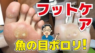 フットケアでウオノメ（魚の目）が取れる瞬間！・Foot Corn removal