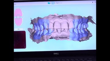 SUNSMILE | QUY TRÌNH LẤY DẤU RĂNG INVISALIGN | 4K