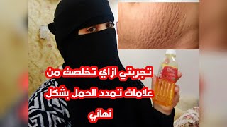 تجربتي في التخلص من علامات تمدد الحمل بشكل نهائي⁦ النتيجه هتبهرك⁦️⁩