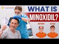 What is Minoxidil? | Types of Minoxidil | How to use Minoxidil? | Dr. Parthasarathi Dutta Roy