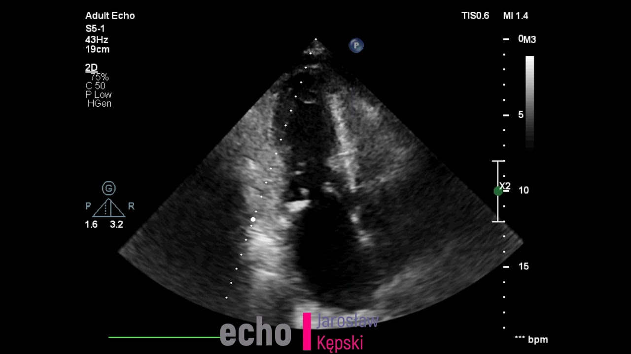 Ciężka niedomykalność zastawki mitralnej (mitralna), Severe Mitral