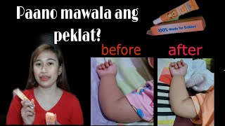 Paano mawala ang peklat? Pantanggal peklat at dark spot kay baby| Kleenfant moisturing scargel