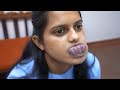 Girl with Large Tumor on lips - Pre Surgery Consultation