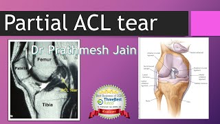 Partial ACL Tear : Detail version. To operate or Not