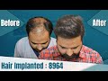 Best hair transplant in india    dhi direct hair implantation