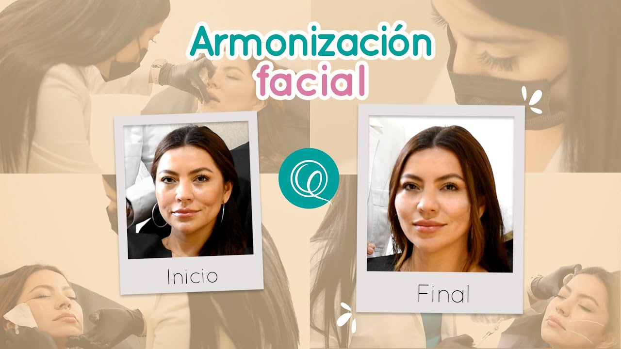 ¡Armonización facial! -  Dra Génesis Quintero