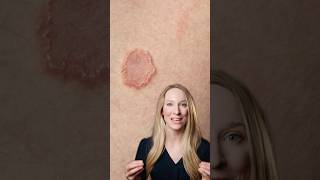 Ringworm is a fungal infection and is contagious! #ringworm #dermatologist #fungus #skincare
