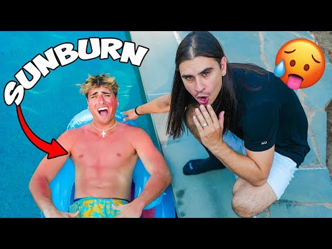 WORSE SUNBURN OF Our Brother’s Life..