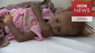 内戦で飢えるイエメンの子供たち