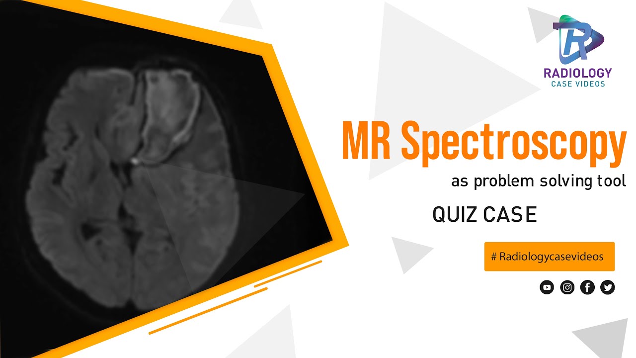 MR Spectroscopy as problem solving tool : Quiz Case - YouTube