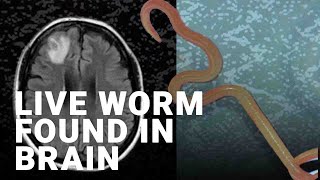 Surgeons find an 8cm live worm inside a woman’s brain
