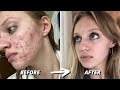 HOW I CLEARED 7 YEARS OF SEVERE ACNE | ACCUTANE JOURNEY