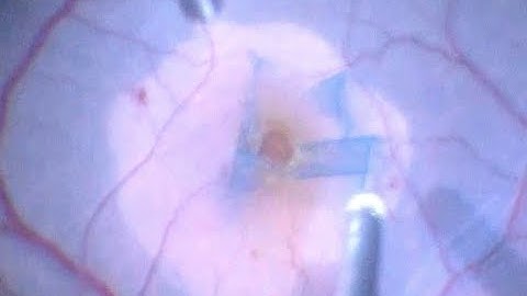 Inverted flap technique for large macular holes