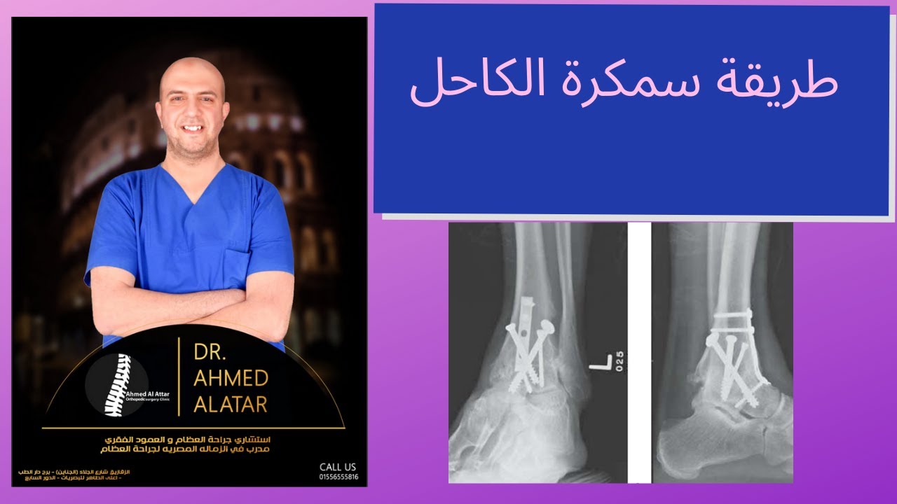 طريقة سمكرة الكاحل د احمد العطار