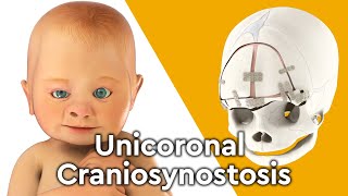 What is Unicoronal Craniosynostosis Surgery?