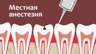 Лечение кариеса orange(Orange clinic. Клиника позитивных эмоций! Оказывает все виды стоматологических услуг. Тел для справок:8(727)2741084,8701707..., 2015-04-13T05:37:19.000Z)