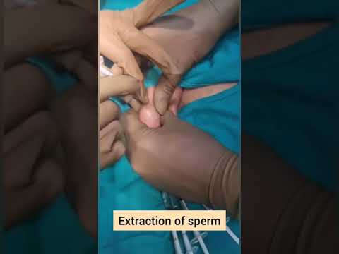 ✅ Testicular Sperm Extraction TESE Procedure #Shorts #tese #spermextraction