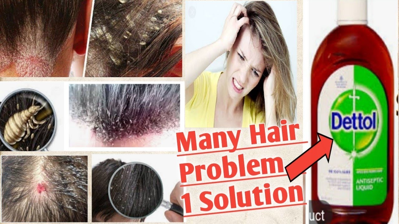 How to apply for Dettol on Hair, Scalp //Many problems are solution
