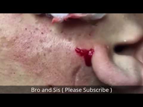 Opps! Must Watch huge cyst removal on man&#;s jawline | Bro and Sis